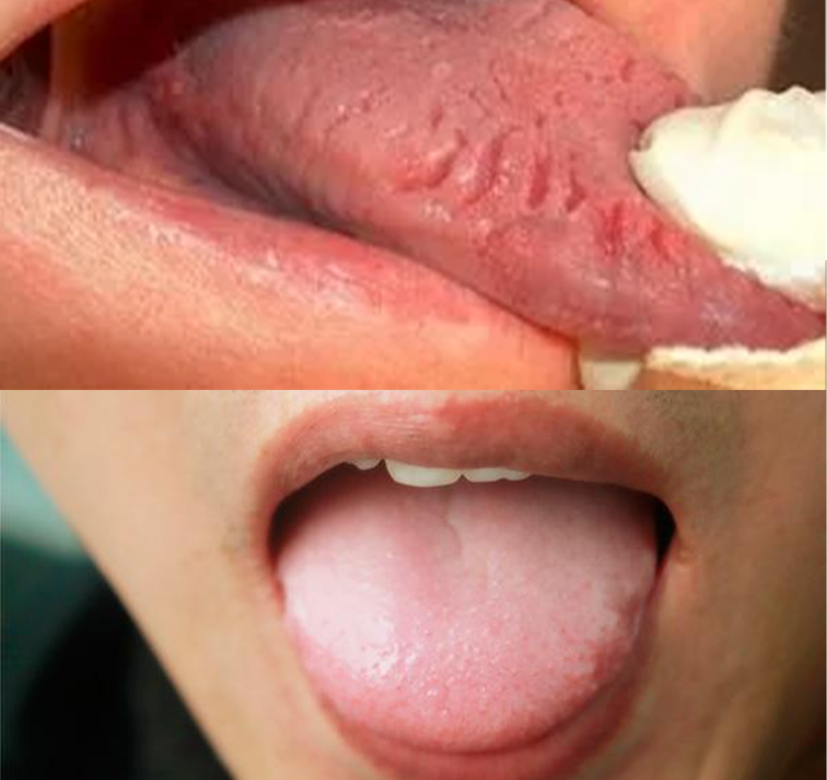 Mewing tongue chewing exercise before and after results
